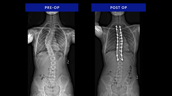 Grace F. | Adolescent Idiopathic Scoliosis
