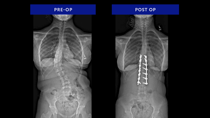 Anonymous 21 | Adolescent Idiopathic Scoliosis