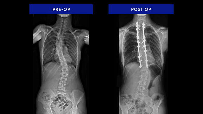 Anonymous 22 | Congenital Scoliosis