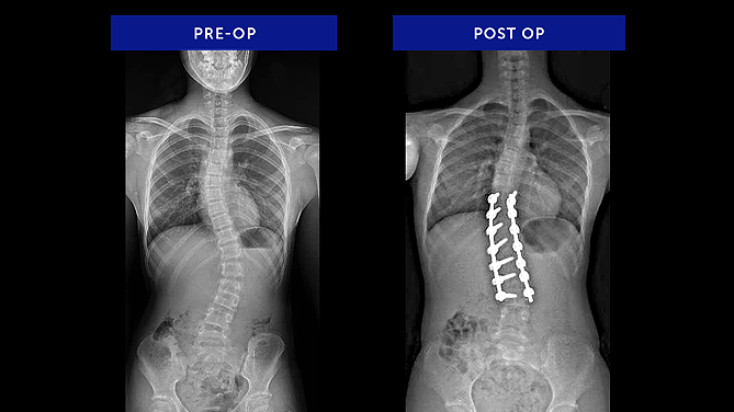 Clara B. | Adolescent Idiopathic Scoliosis