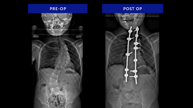 Emily K. | Congenital Scoliosis