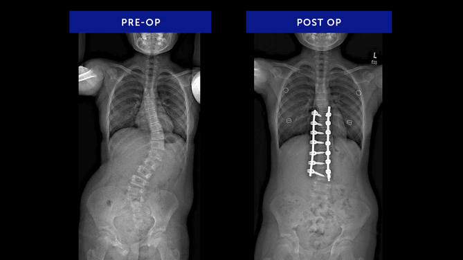 Kaitlyn J. | Neuromuscular Scoliosis