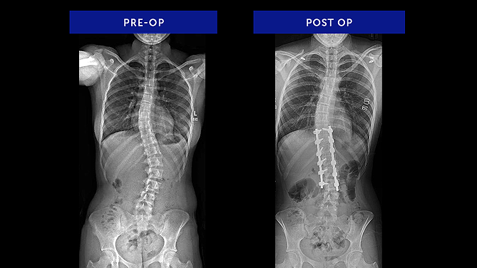 Keira L. | Adolescent Idiopathic Scoliosis