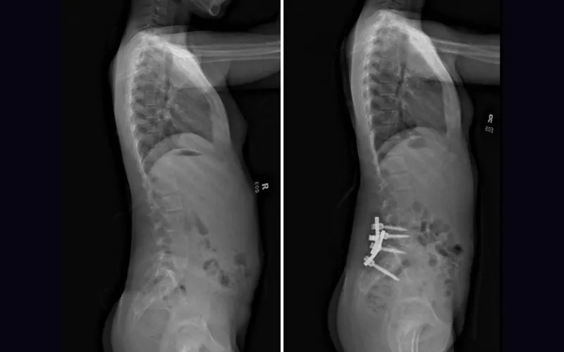 advances-peds-neuro-ortho-2025-progressive congenital scoliosis