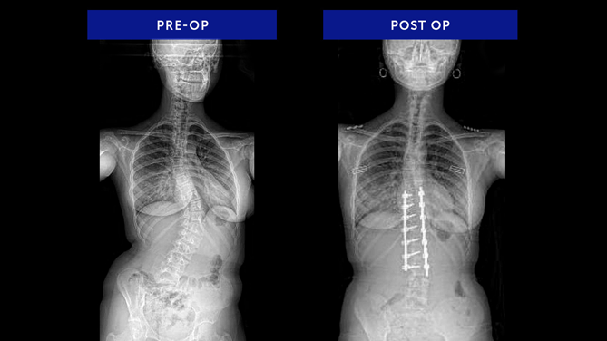 Anonymous 24 | Adolescent Idiopathic Scoliosis