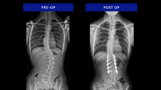 Anonymous 25 | Adolescent Idiopathic Scoliosis