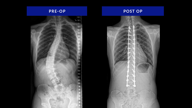 Anonymous 26 | Adolescent Idiopathic Scoliosis
