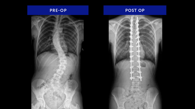 Anonymous 27 | Adolescent Idiopathic Scoliosis