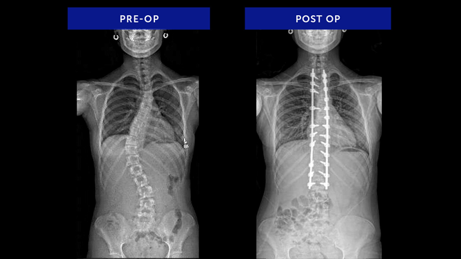 Anonymous 23 | Juvenile Idiopathic Scoliosis