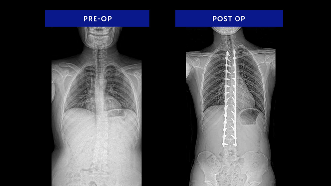 JZ | Scheuermann’s Kyphosis