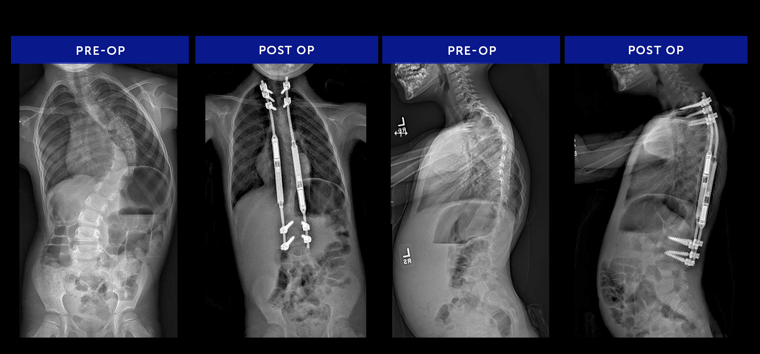 Commonly Performed Scoliosis Surgery-Ava-R-MAGEC