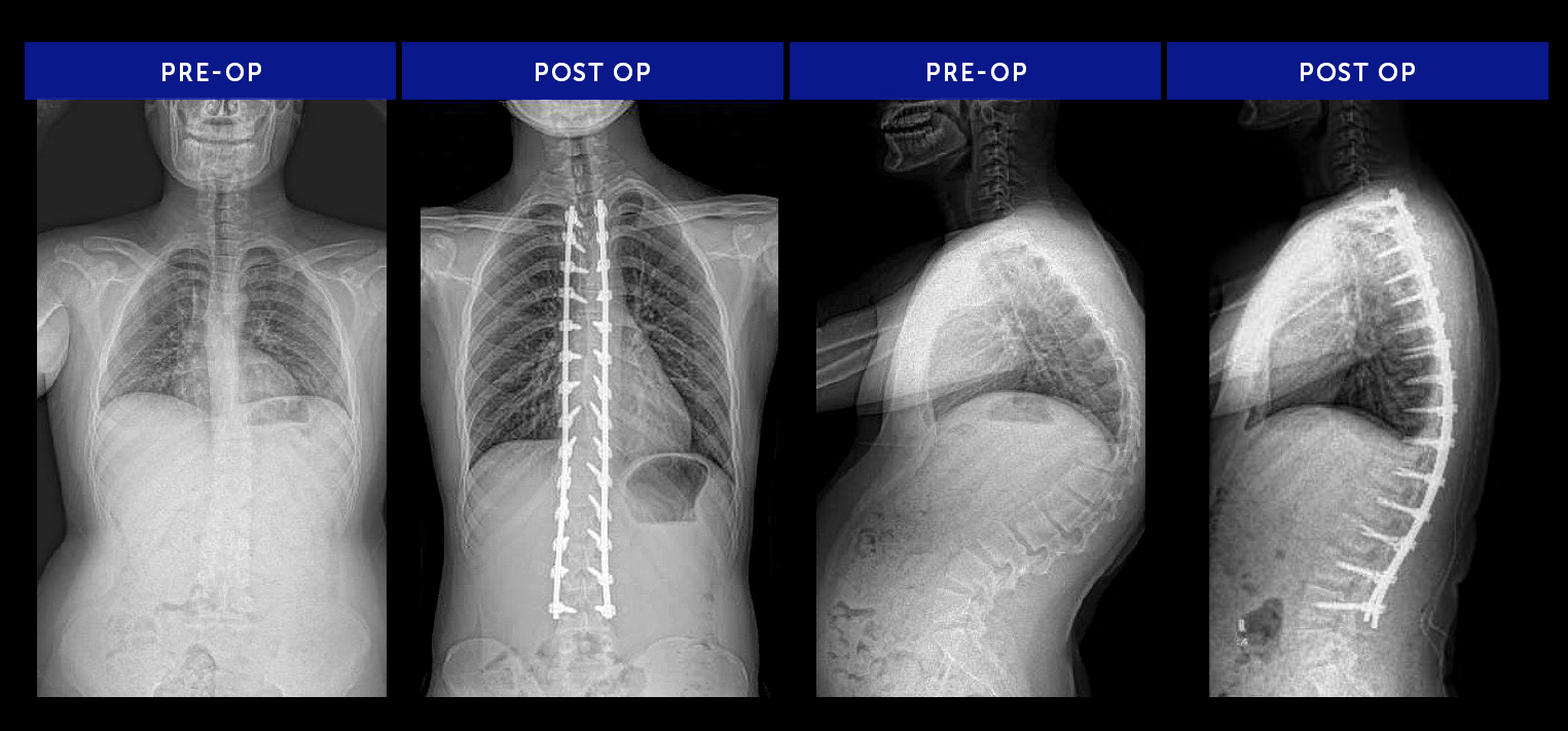 Commonly-Anony25-Scheuermann's Kyphosis