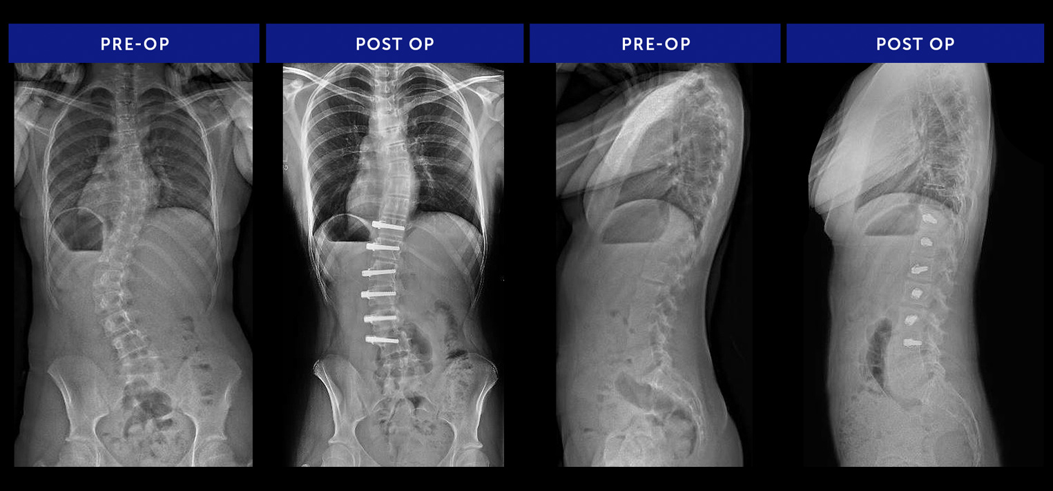 Scoliosis-Surgeries-Commonly-Performed-AVBT