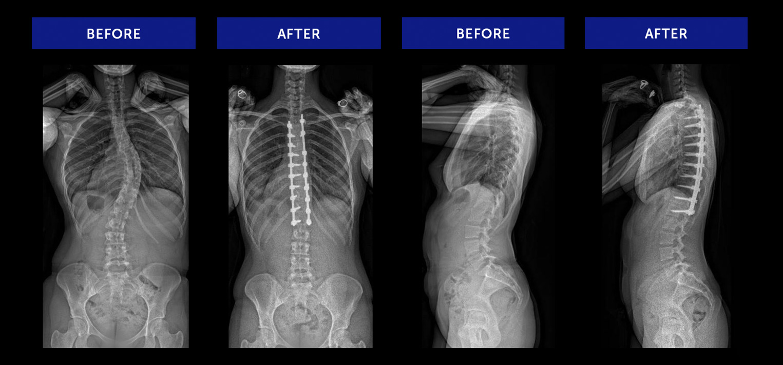Scoliosis-Surgeries-Commonly-Performed-Fusion-L1