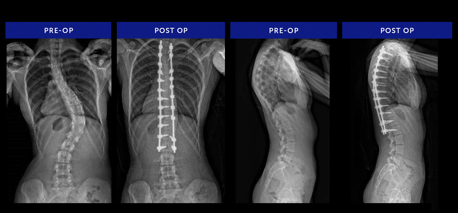 Scoliosis-Surgeries-Commonly-Performed-Fusion-L2