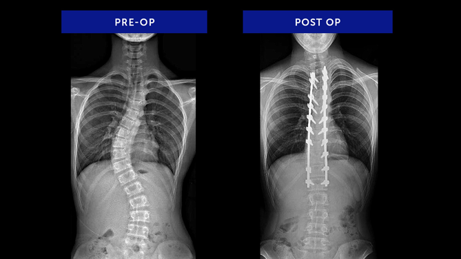 Anonymous 28 | Adolescent Idiopathic Scoliosis