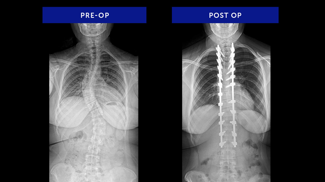 Anonymous 29 | Adolescent Idiopathic Scoliosis