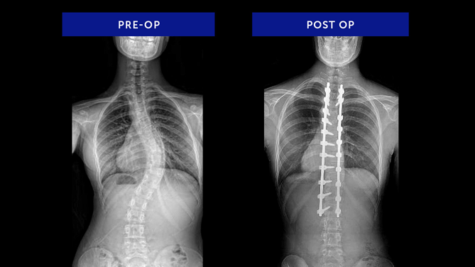 Anonymous 30 | Adolescent Idiopathic Scoliosis