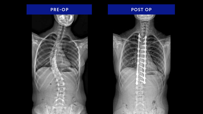 Anonymous 31 | Adolescent Idiopathic Scoliosis