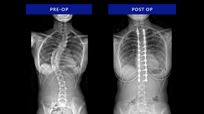 Addison | Adolescent Idiopathic Scoliosis