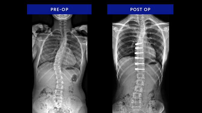 Anonymous 33 | Juvenile Idiopathic Scoliosis