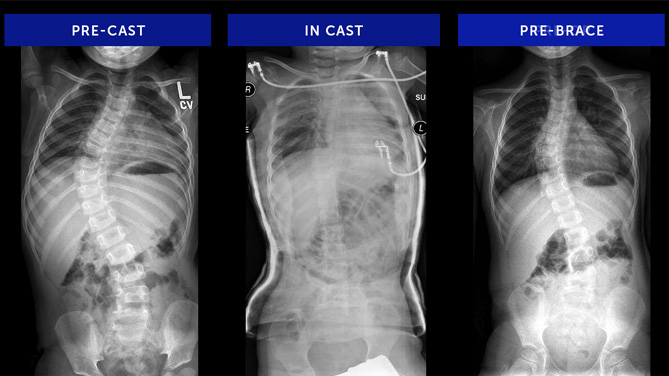 Dana | Infantile Scoliosis